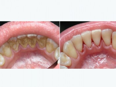 УЗ чистка: удаление твердых зубных отложений (камней)