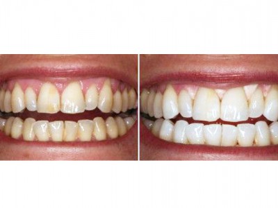 Air Flow - очищение зубов от темного налета (от курения, чая и кофе), возвращение зубам естественного цвета
