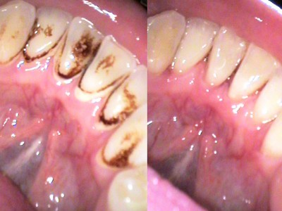 Результат профессиональной чистки зубов у стоматолога